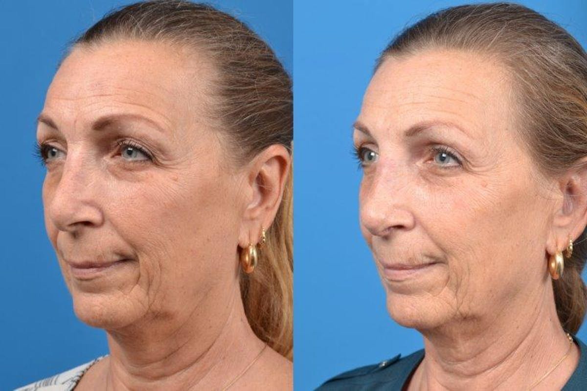 Rhinoplasty Before & After Gallery - Patient 122406614 - Image 4