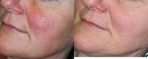 Skin Resurfacing Before & After Gallery - Patient 122406613 - Image 1