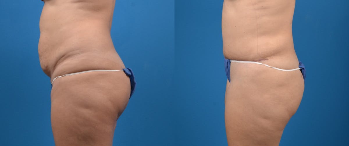 Tummy Tuck Before & After Gallery - Patient 402066 - Image 2