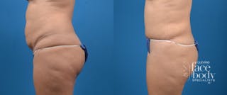 Hidden Tummy Tuck Before & After Gallery - Patient 191614 - Image 2