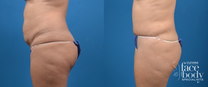 Hidden Tummy Tuck Before & After Gallery - Patient 191614 - Image 2