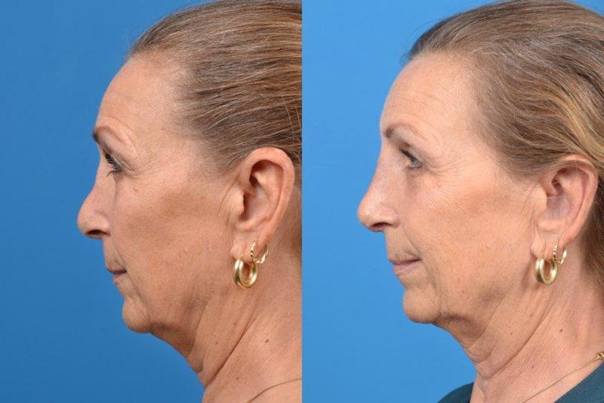 Rhinoplasty Before & After Gallery - Patient 122406614 - Image 5