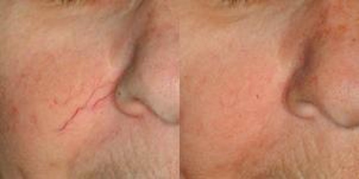 Skin Resurfacing Before & After Gallery - Patient 122406615 - Image 1
