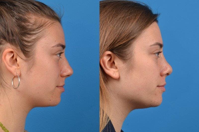 Rhinoplasty Before & After Gallery - Patient 122406618 - Image 1