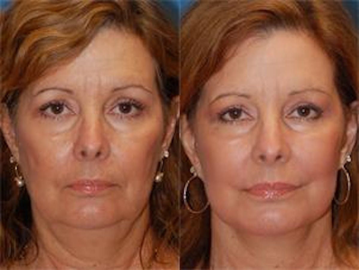 Skin Resurfacing Before & After Gallery - Patient 122406617 - Image 1