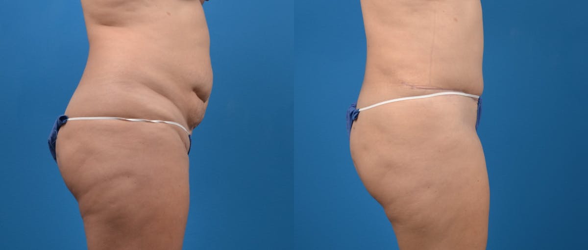 Hidden Tummy Tuck Before & After Gallery - Patient 191614 - Image 3