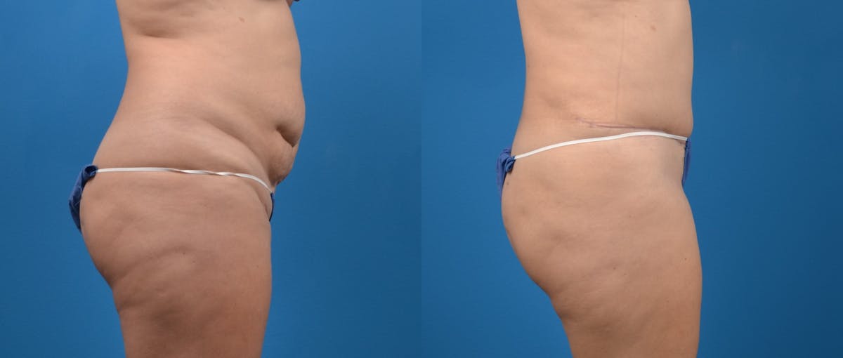 Tummy Tuck Before & After Gallery - Patient 122406616 - Image 3