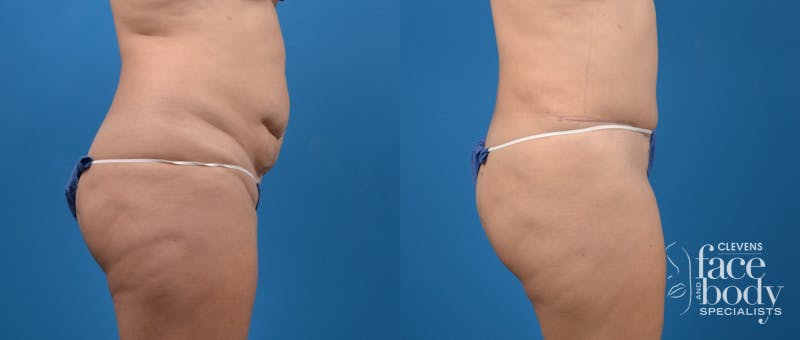 Hidden Tummy Tuck Before & After Gallery - Patient 191614 - Image 3