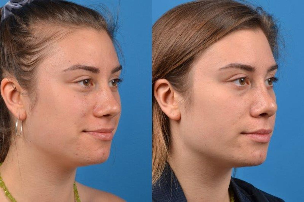 Rhinoplasty Before & After Gallery - Patient 122406618 - Image 2