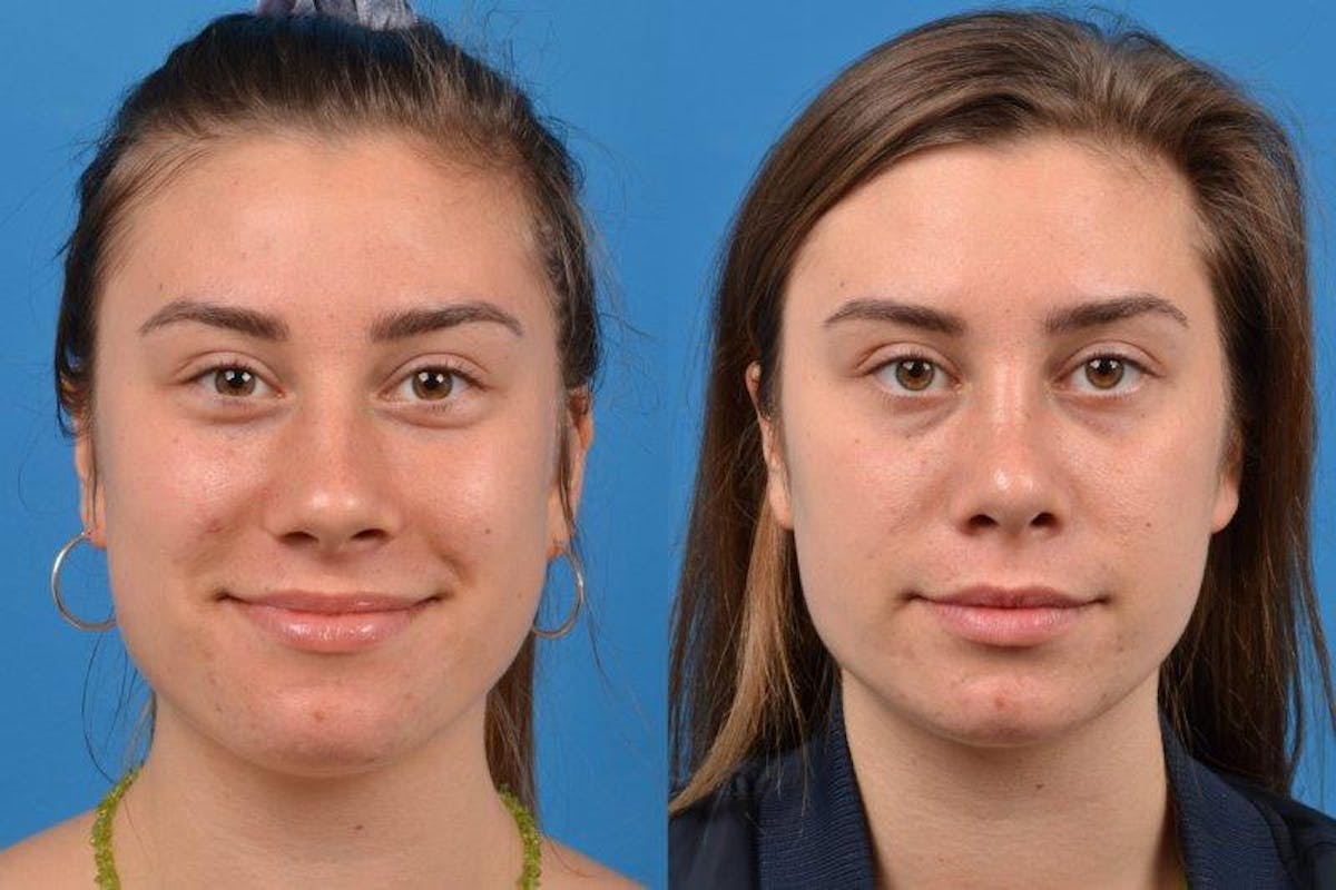Rhinoplasty Before & After Gallery - Patient 122406618 - Image 3