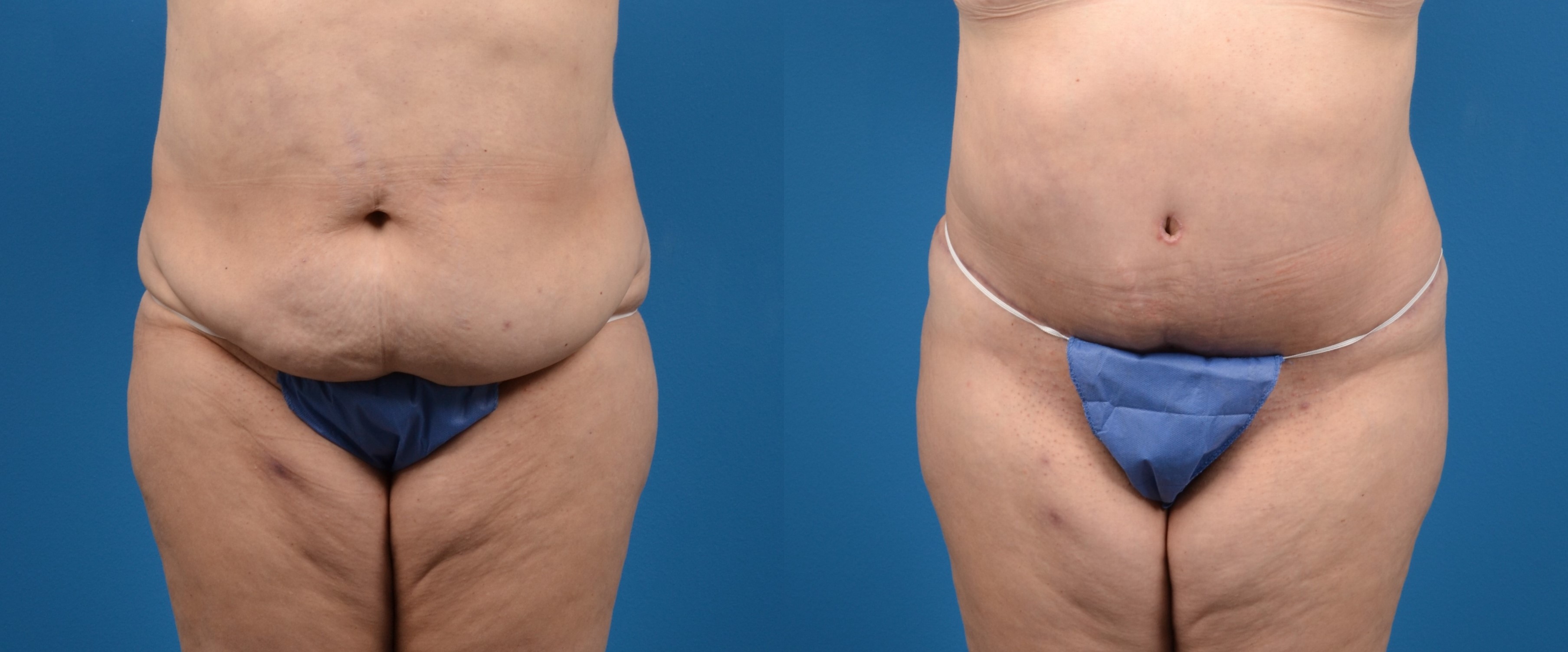Hidden Tummy Tuck Before & After Gallery - Patient 401701 - Image 1