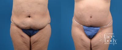 Hidden Tummy Tuck Before & After Gallery - Patient 401701 - Image 1
