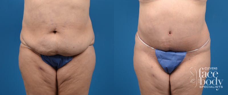 Hidden Tummy Tuck Before & After Gallery - Patient 401701 - Image 1