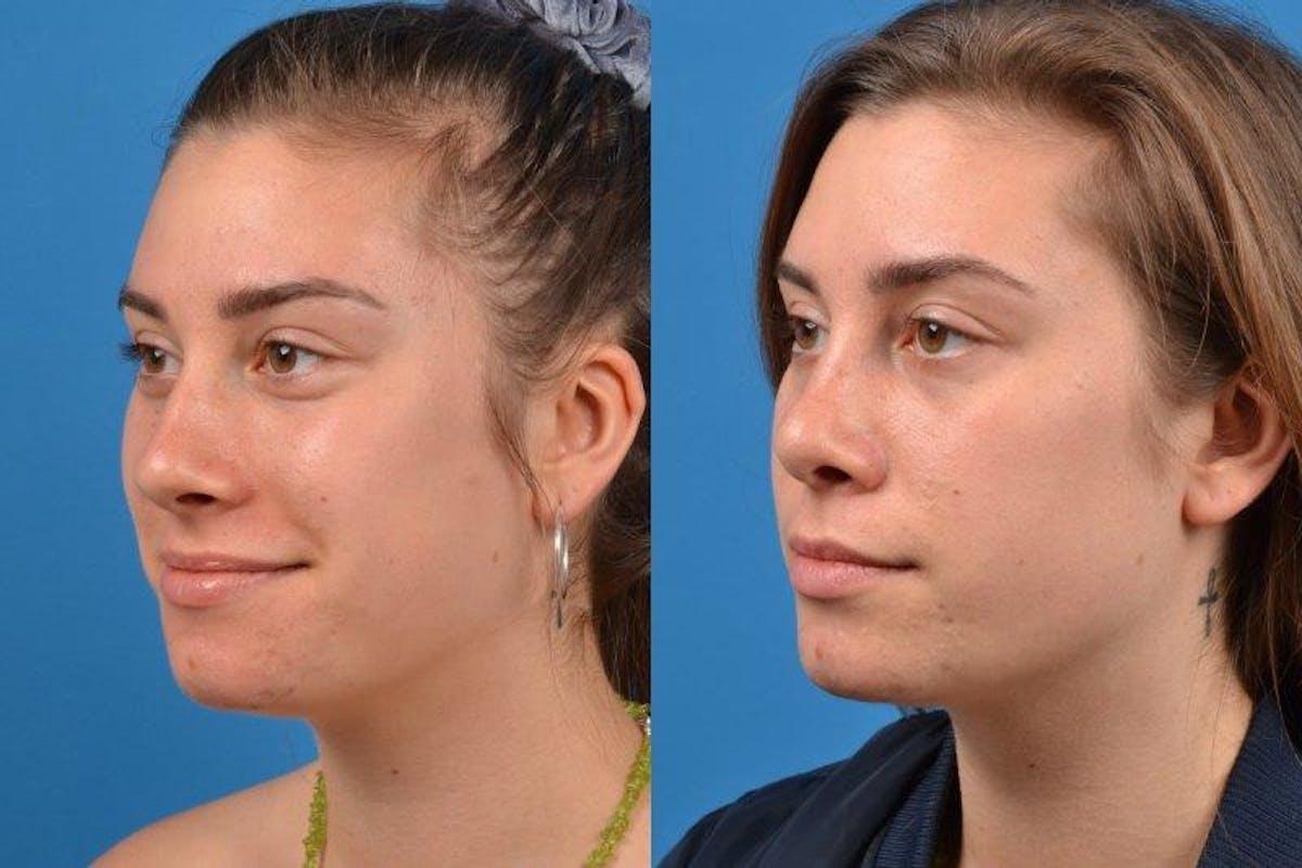 Rhinoplasty Before & After Gallery - Patient 122406618 - Image 4