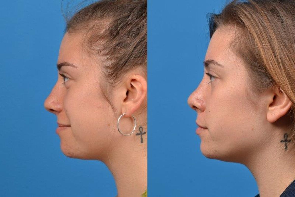 Rhinoplasty Before & After Gallery - Patient 122406618 - Image 5