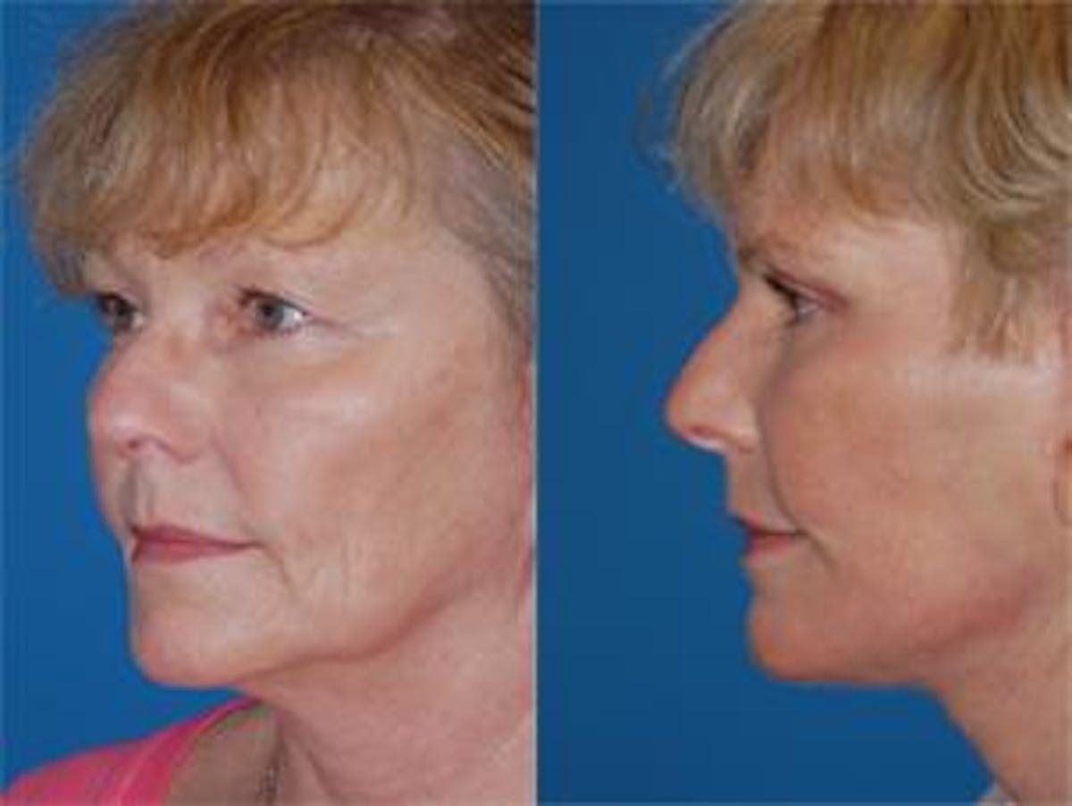 Skin Resurfacing Before & After Gallery - Patient 122406619 - Image 2
