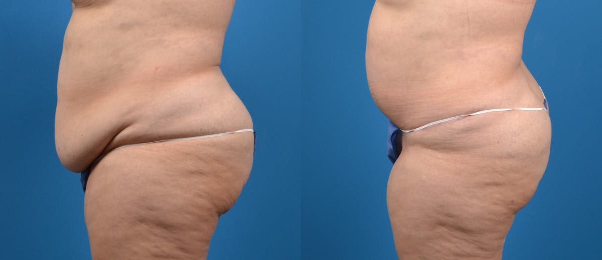 Tummy Tuck Before & After Gallery - Patient 393613 - Image 2