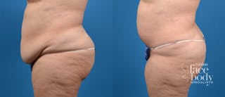 Hidden Tummy Tuck Before & After Gallery - Patient 401701 - Image 2
