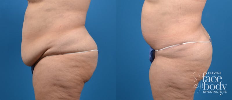 Hidden Tummy Tuck Before & After Gallery - Patient 401701 - Image 2