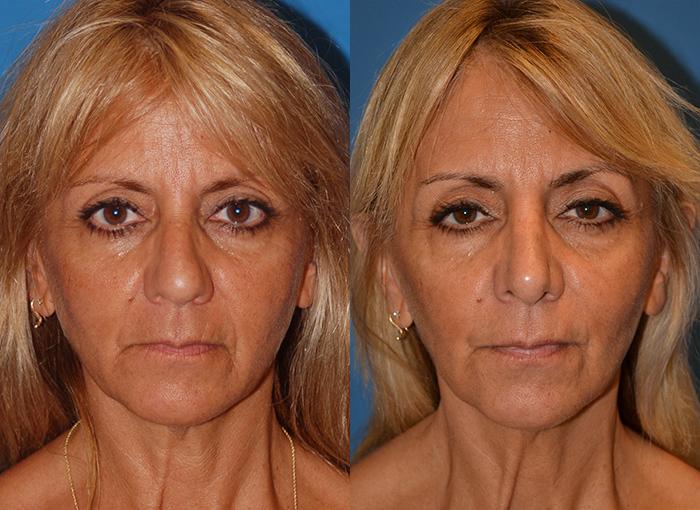 Rhinoplasty Before & After Gallery - Patient 122406621 - Image 1
