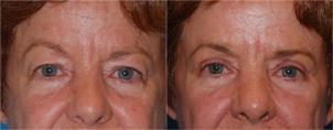 Eyelid Surgery Before & After Gallery - Patient 850607 - Image 1