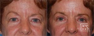 Eyelid Surgery Before & After Gallery - Patient 850607 - Image 1