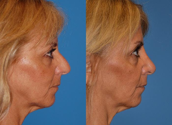 Rhinoplasty Before & After Gallery - Patient 122406621 - Image 2