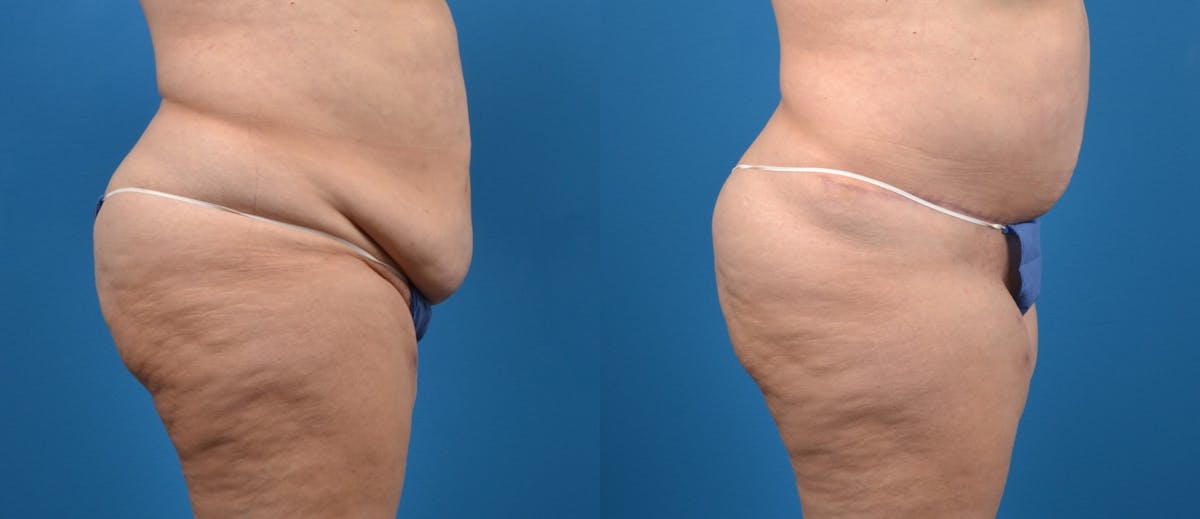 Tummy Tuck Before & After Gallery - Patient 393613 - Image 3
