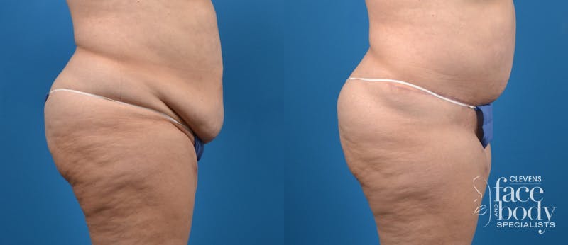 Hidden Tummy Tuck Before & After Gallery - Patient 401701 - Image 3