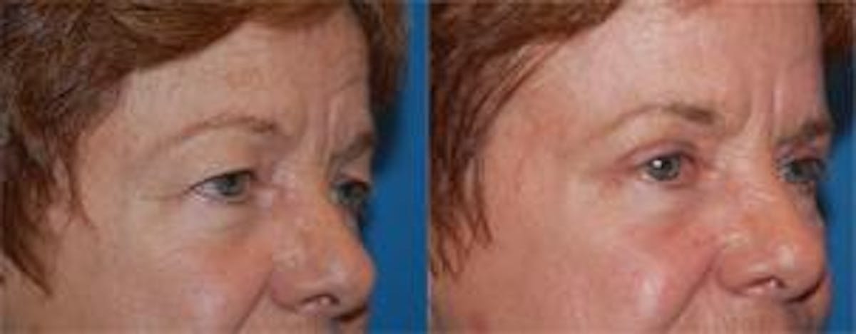 Skin Resurfacing Before & After Gallery - Patient 122406622 - Image 2