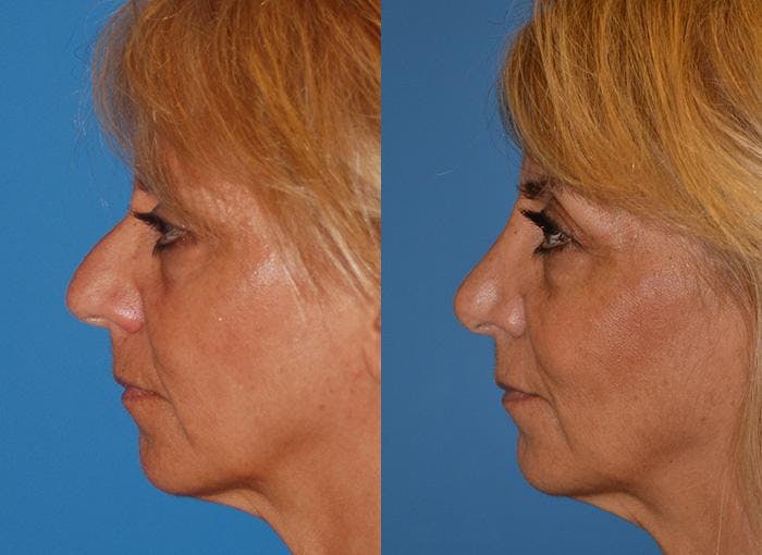 Rhinoplasty Before & After Gallery - Patient 122406621 - Image 3