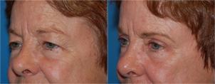 Eyelid Surgery Before & After Gallery - Patient 850607 - Image 2