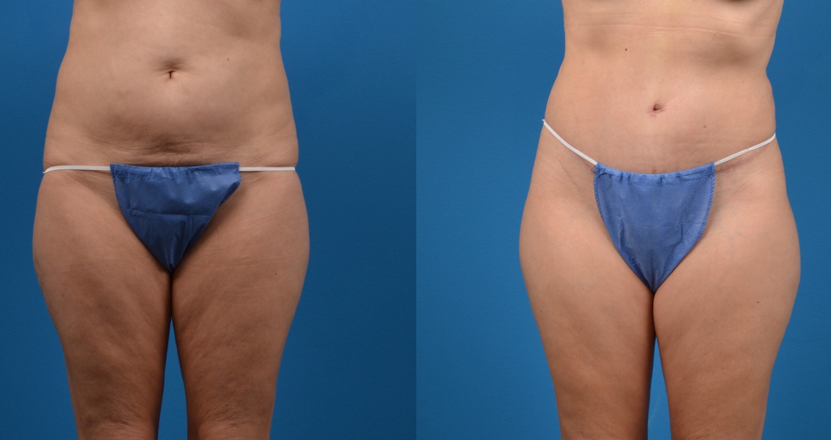 Hidden Tummy Tuck Before & After Gallery - Patient 951048 - Image 1