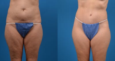 Tummy Tuck Before & After Gallery - Patient 122406626 - Image 1