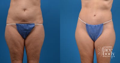 Hidden Tummy Tuck Before & After Gallery - Patient 951048 - Image 1