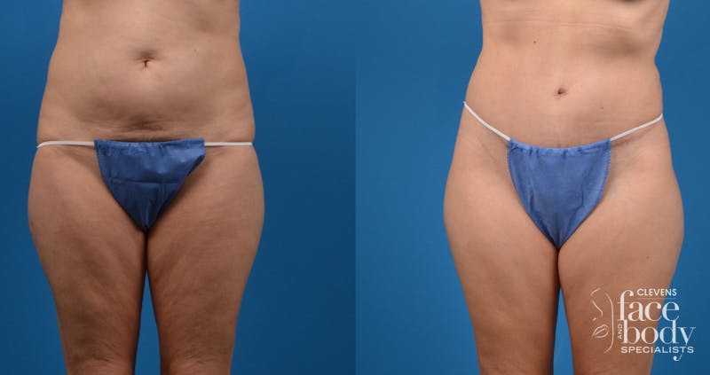 Hidden Tummy Tuck Before & After Gallery - Patient 951048 - Image 1