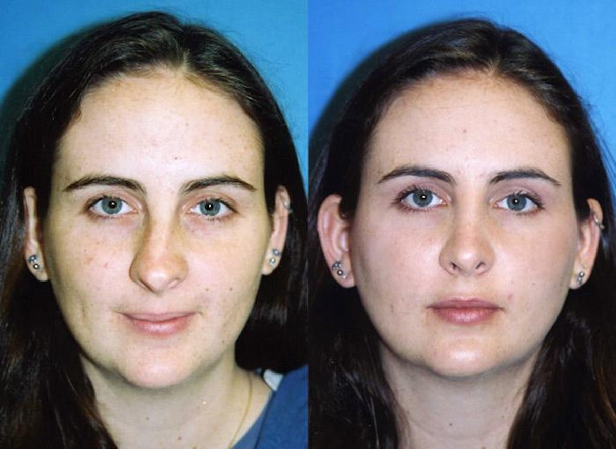 Rhinoplasty Before & After Gallery - Patient 122406623 - Image 1