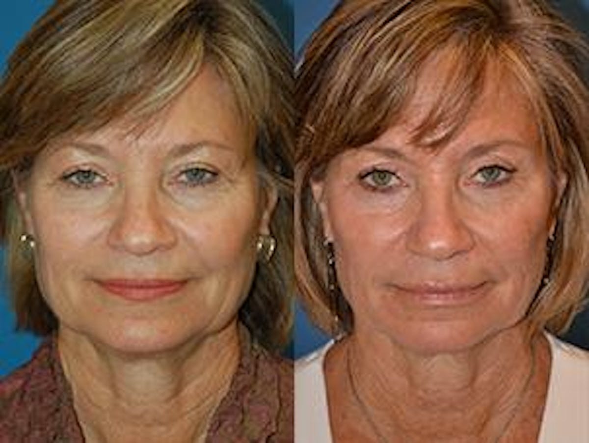 Skin Resurfacing Before & After Gallery - Patient 122406624 - Image 1