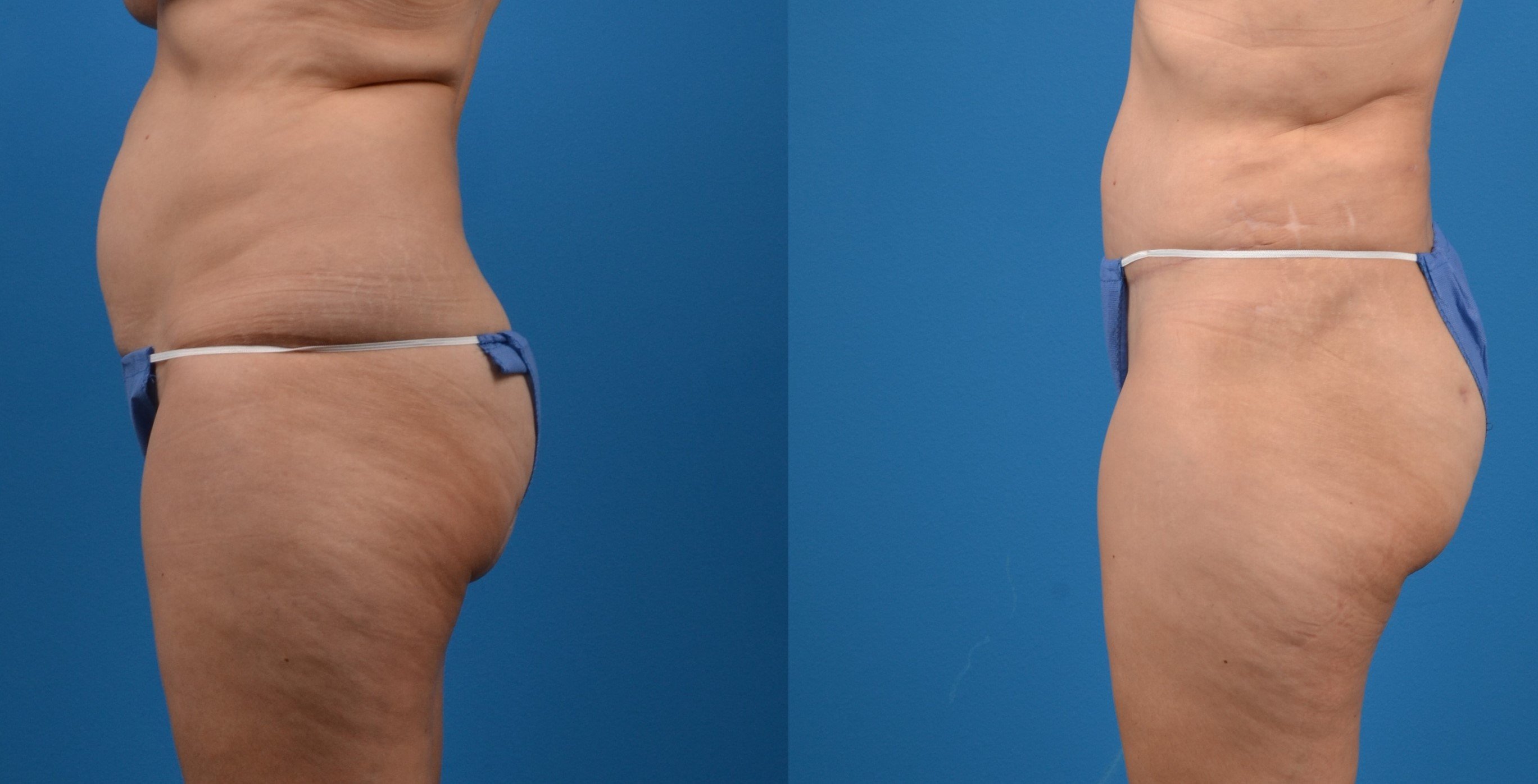 Hidden Tummy Tuck Before & After Gallery - Patient 951048 - Image 2