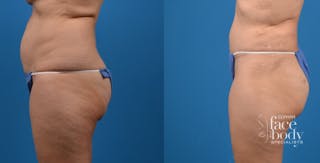 Hidden Tummy Tuck Before & After Gallery - Patient 951048 - Image 2