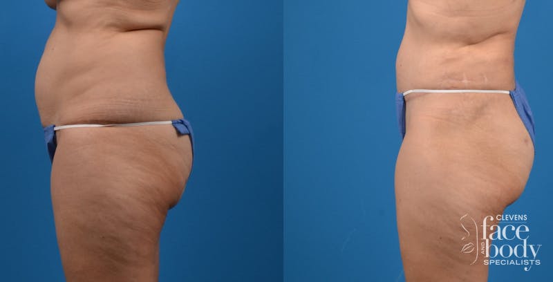 Hidden Tummy Tuck Before & After Gallery - Patient 951048 - Image 2