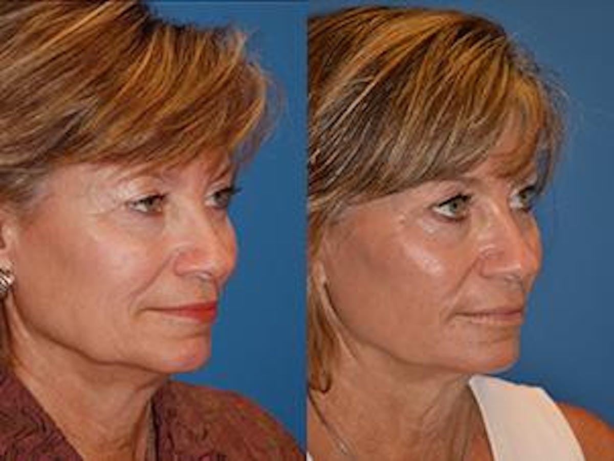 Skin Resurfacing Before & After Gallery - Patient 122406624 - Image 2