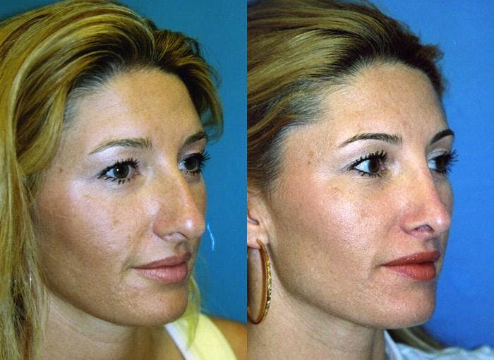 Rhinoplasty Before & After Gallery - Patient 122406625 - Image 1