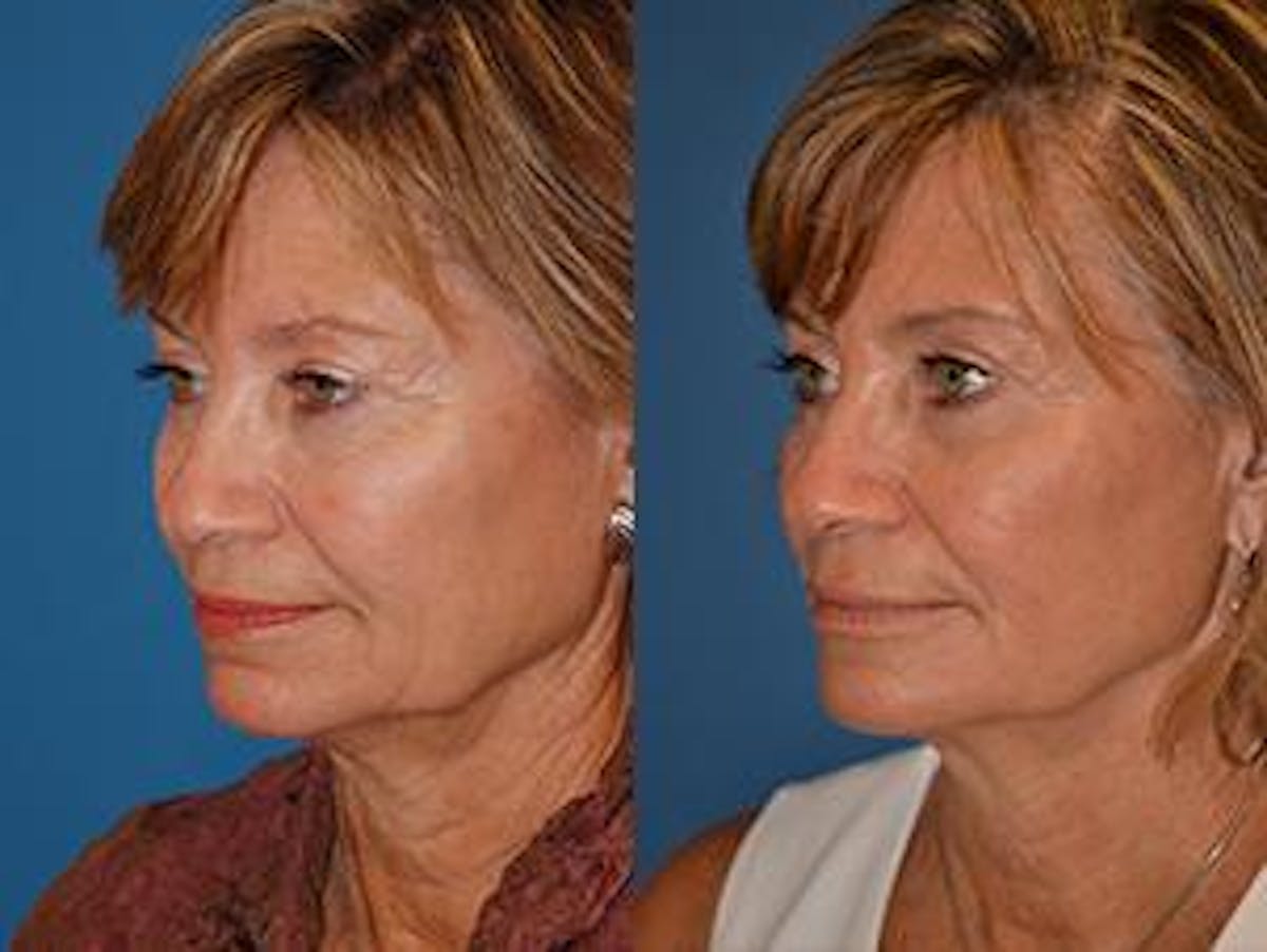 Skin Resurfacing Before & After Gallery - Patient 122406624 - Image 3
