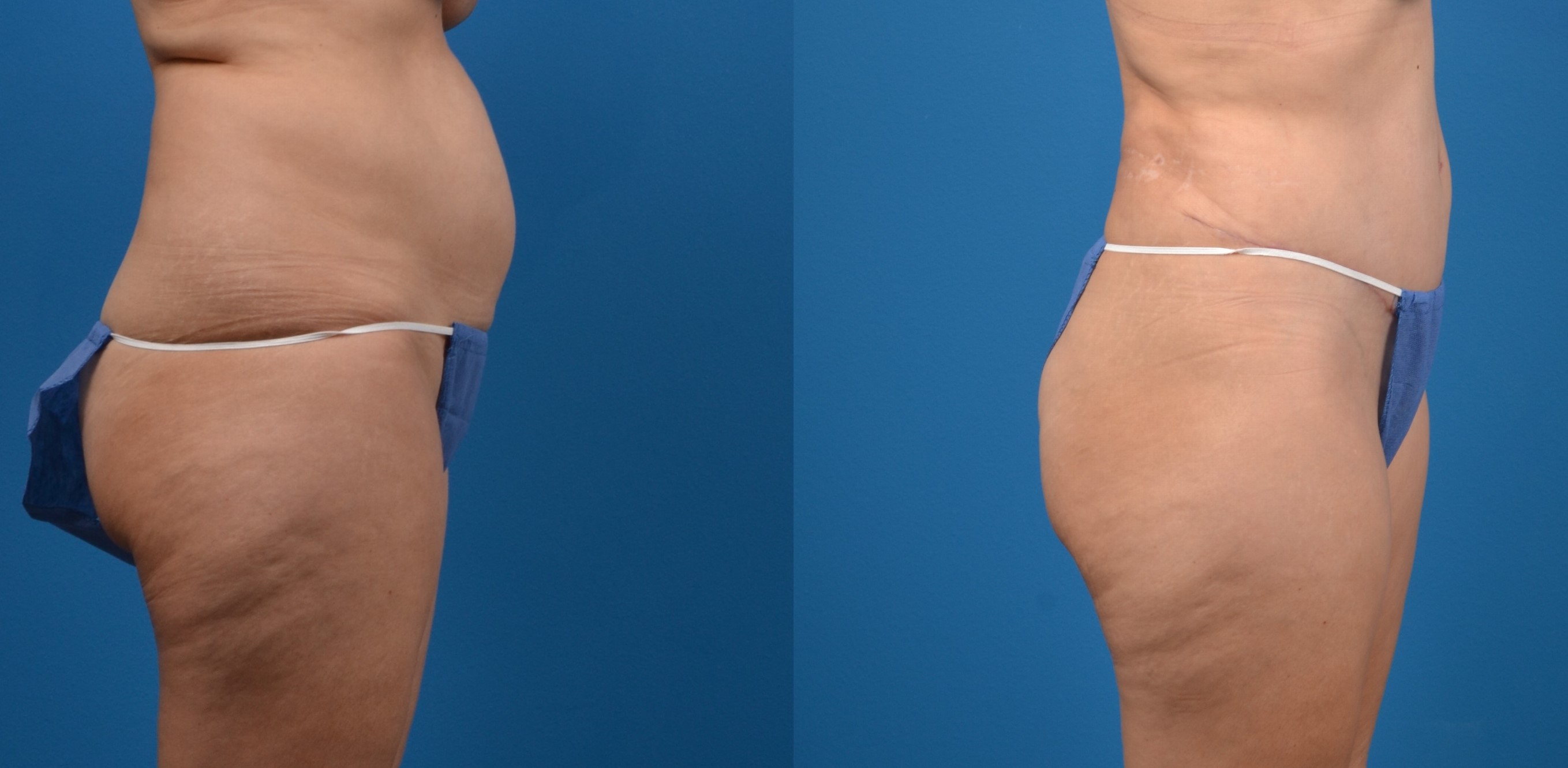 Hidden Tummy Tuck Before & After Gallery - Patient 951048 - Image 3
