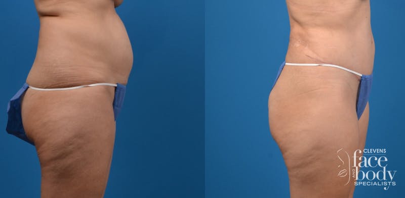 Hidden Tummy Tuck Before & After Gallery - Patient 951048 - Image 3