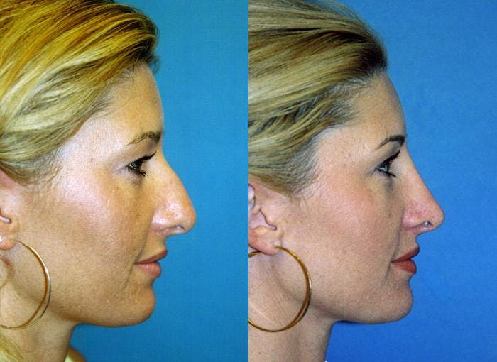 Rhinoplasty Before & After Gallery - Patient 122406625 - Image 2