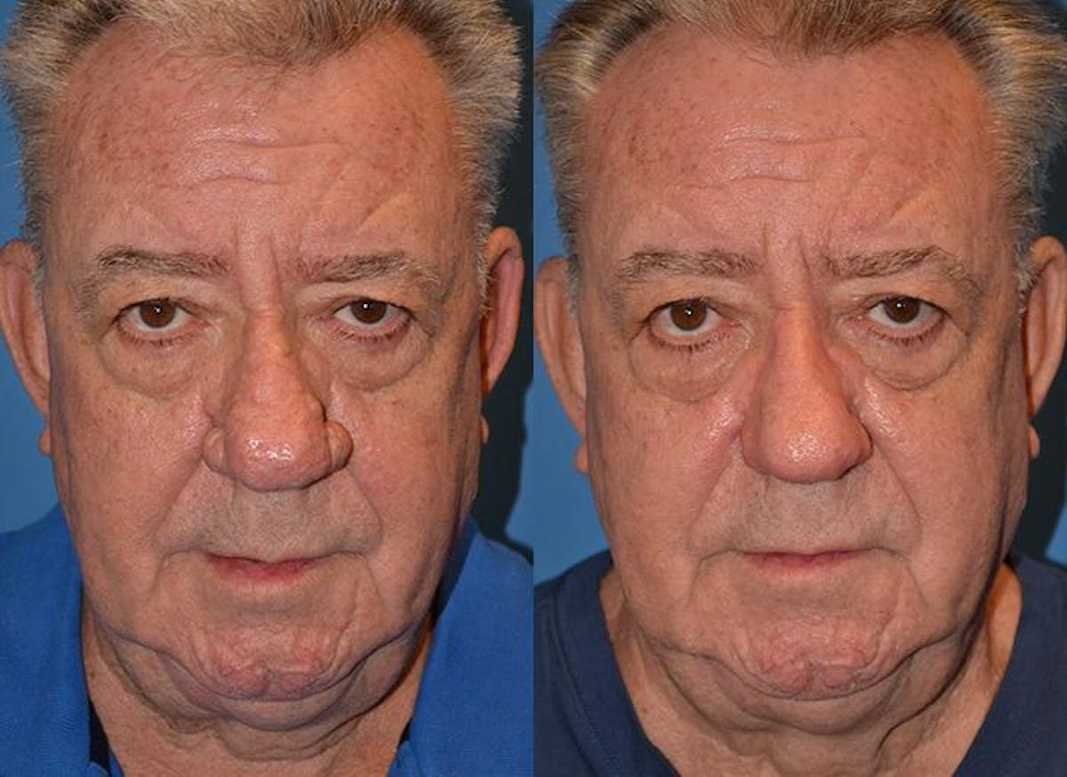 Skin Resurfacing Before & After Gallery - Patient 122406628 - Image 1