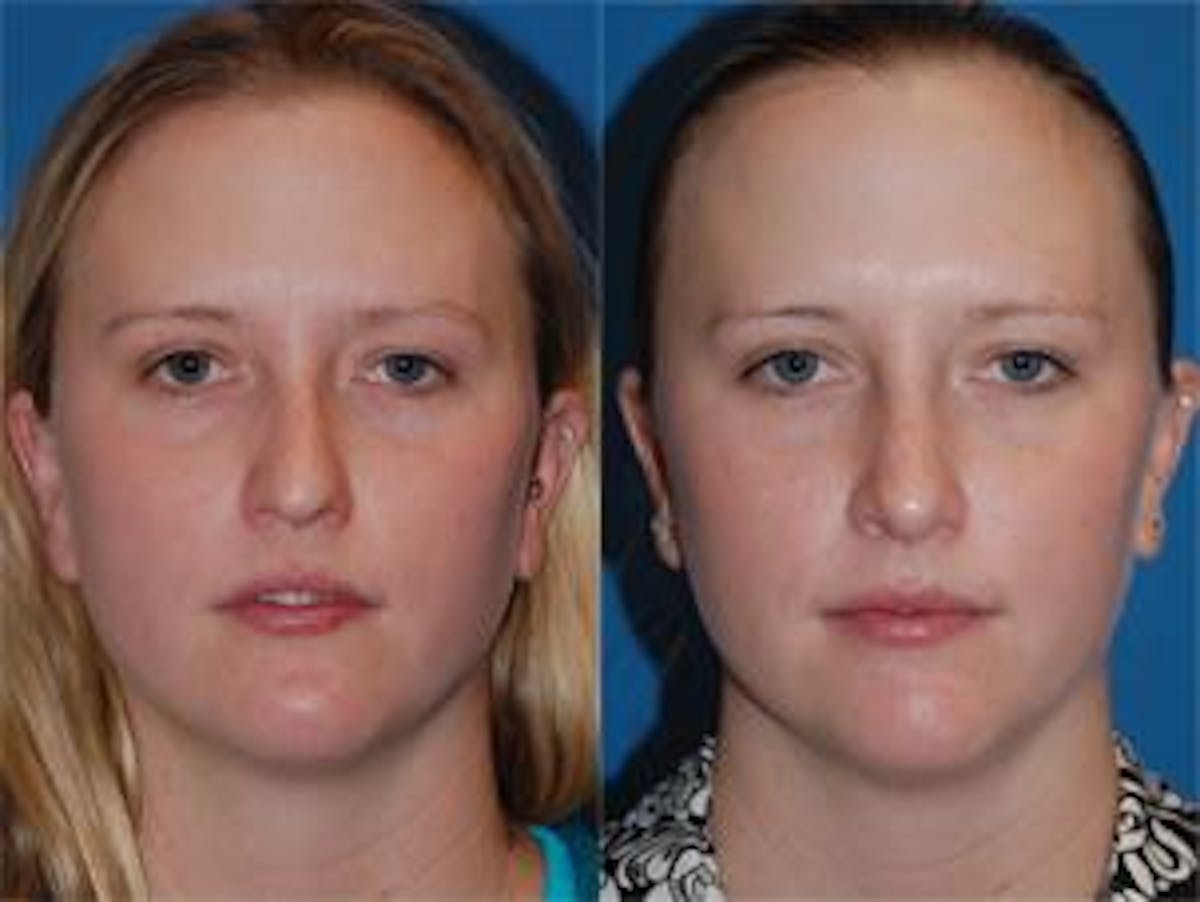 Rhinoplasty Before & After Gallery - Patient 122406627 - Image 1