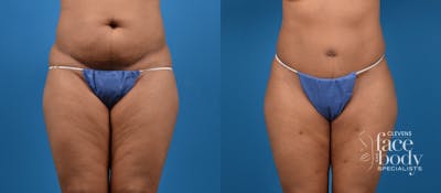 Hidden Tummy Tuck Before & After Gallery - Patient 533958 - Image 1